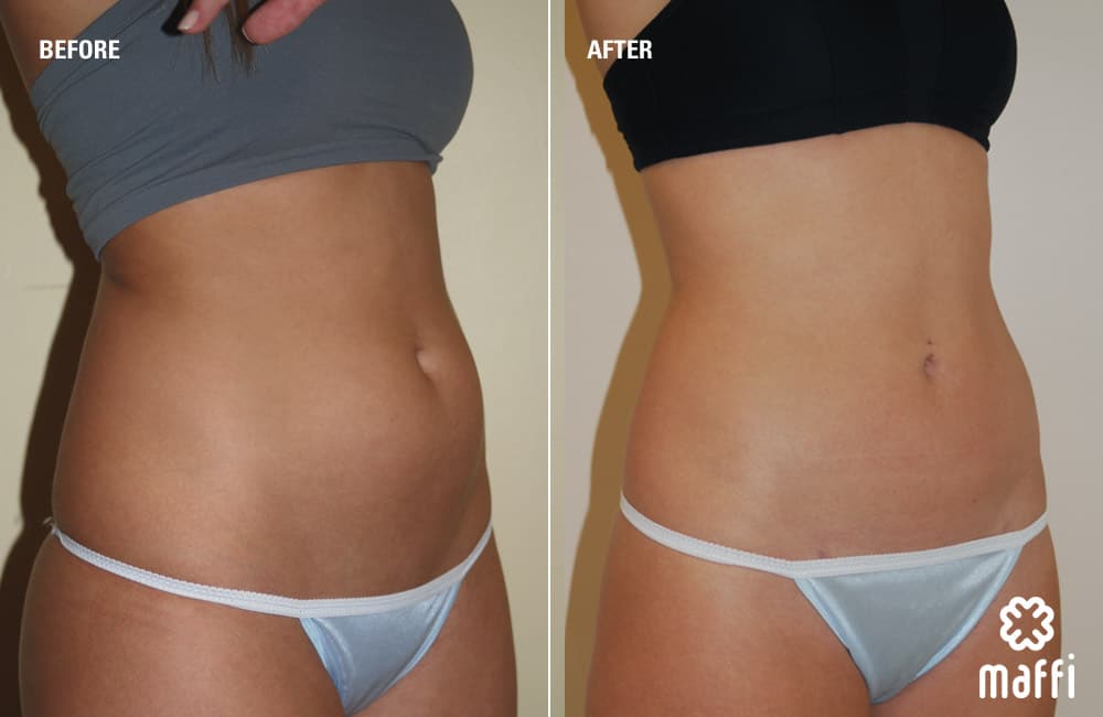 Before After Img