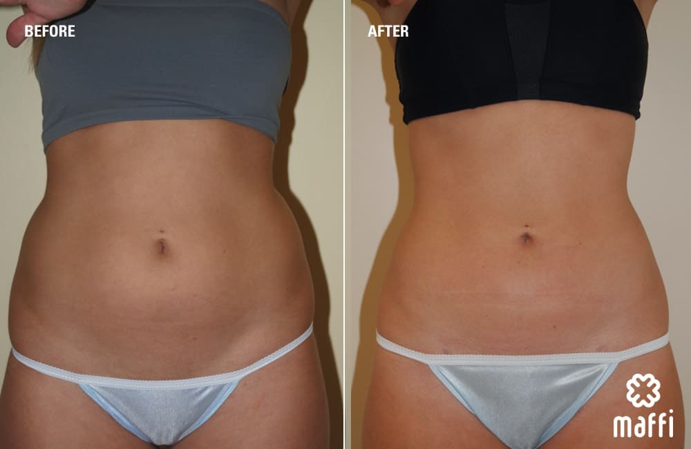 Before After Img