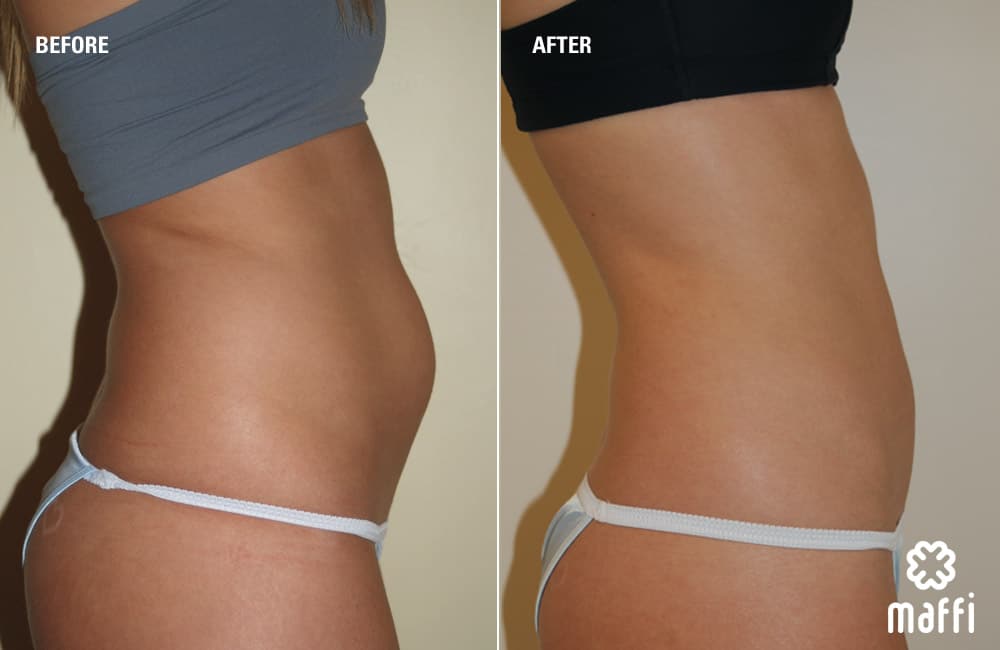 Before After Img